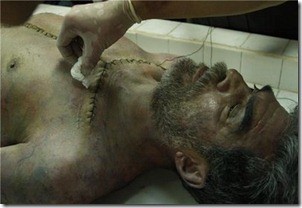 Kan Kokusu Fotoğrafı